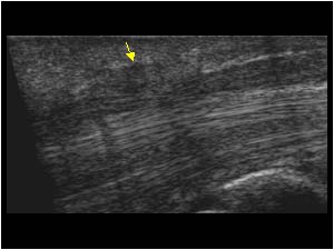 Median nerve with scar tissue longitudinal