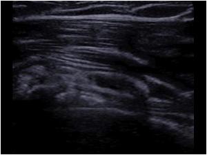 Resorbing calcifications in the bursa anterior of the biceps tendon longitudinal view