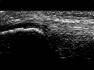 Lower pole of the patella and proximal patellar tendon longitudinal normal