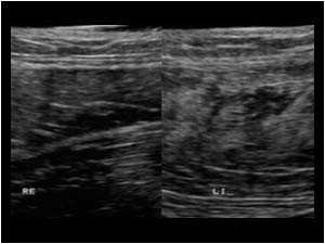 Normal muscle and muscle rupture with fibrosis