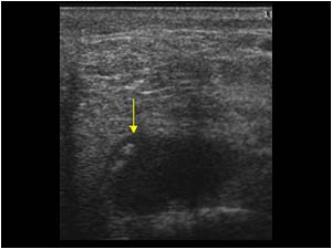 Effusion and loose bodies in the dorsal left ankle