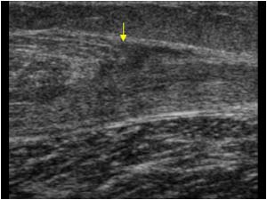 Distal gastrocnemius muscle rupture longitudinal