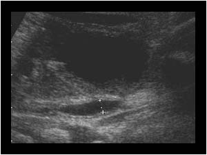 Reflux in the left ureter with slight dilatation longitudinal
