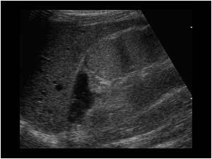 Remnants of a cystic dysplastic upperpole