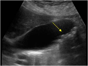 cholelithiasis ultrasound