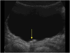 bladder stone ultrasound
