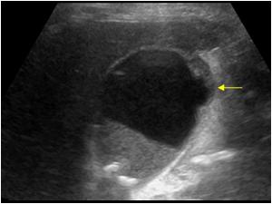 perforated gallbladder ultrasound