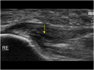ultrasound plantar fascia