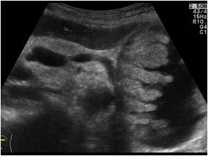pancreatic pseudocyst ultrasound