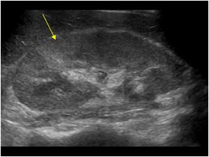 chronic pyelonephritis ultrasound