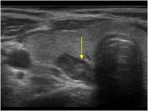 parathyroid gland ultrasound