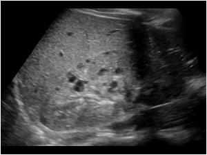 adult polycystic kidney disease ultrasound