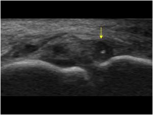 ulnar collateral ligament thumb ultrasound