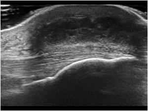 prepatellar bursitis ultrasound