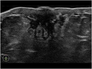 male gynecomastia ultrasound