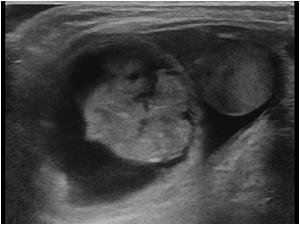 scrotal hernia ultrasound