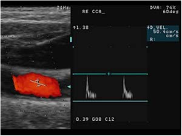 Abnormal Carotid Artery Ultrasound