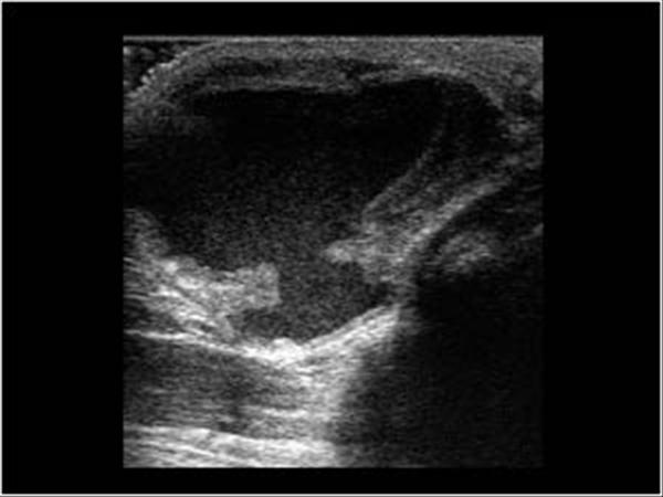 thyroglossal duct cyst ultrasound