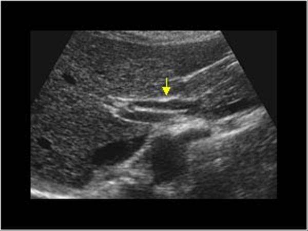 common hepatic duct ultrasound