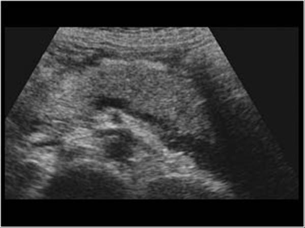 Hemorrhagic Pancreatitis Ultrasound