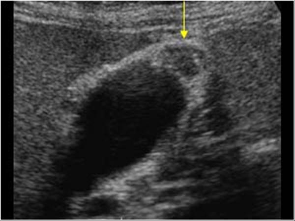Adenomyomatosis Ultrasound