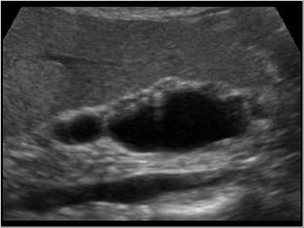 Adenomyomatosis Ultrasound