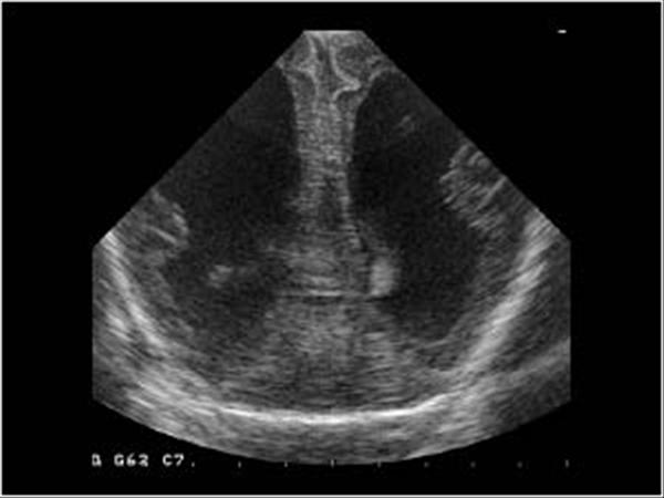 lissencephaly ultrasound