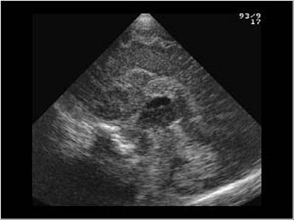 lissencephaly ultrasound
